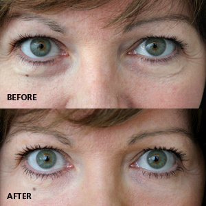 download under eyes treatment