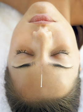 Facial acupuncture Facial acupuncture
