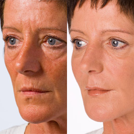 Non surgical fillers