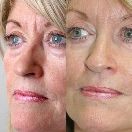 No surgery facelift No surgery facelift