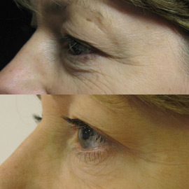 Botox eye lift