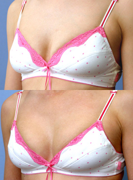 Breast fillers