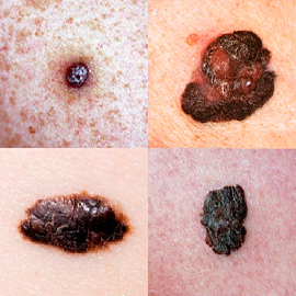 Skin cancer signs Skin cancer signs