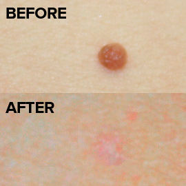 Mole and skin tag Removal