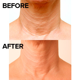 Restylane Vital Light treatment